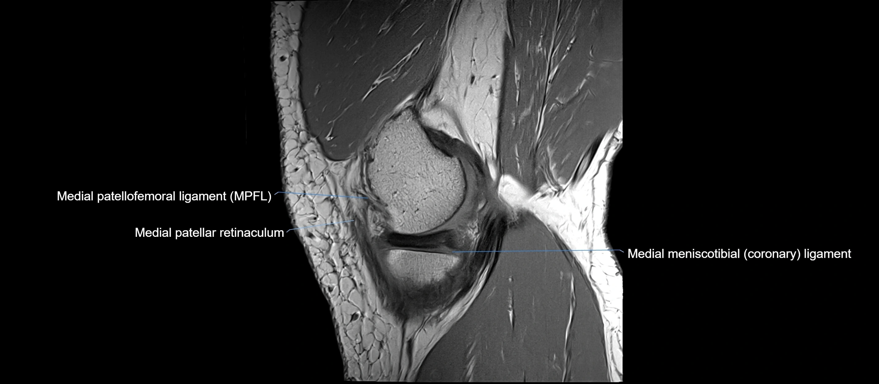 MRI sagittal  ligaments cross sectional anatomy 3T  radiology  image-img-00001-00011.webp